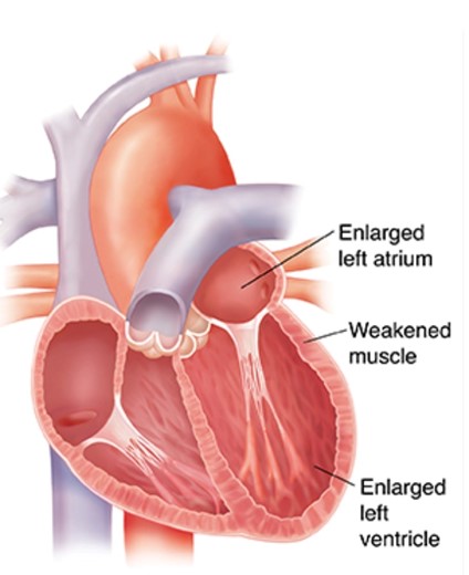 Cardiomyopathy diagram
