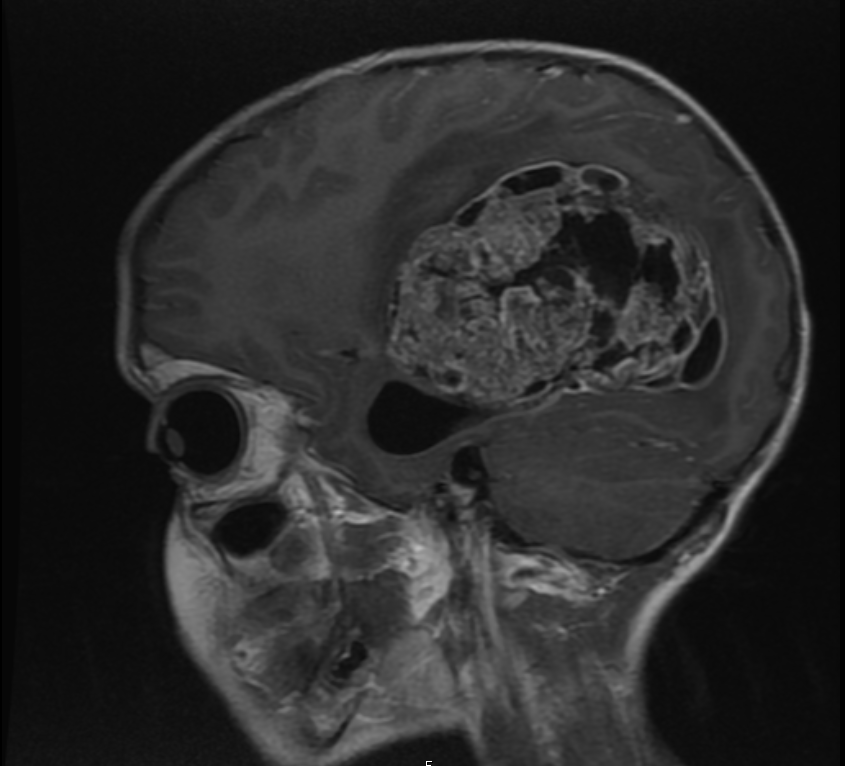 Zachary's brain scan