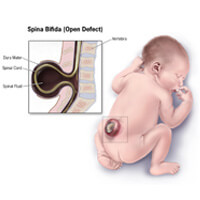 Spina Bifida infant diagram