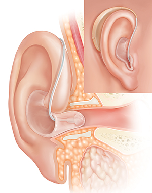 Cross section of ear showing outer ear structures with behind-the-ear hearing aid in place and inset of external view.